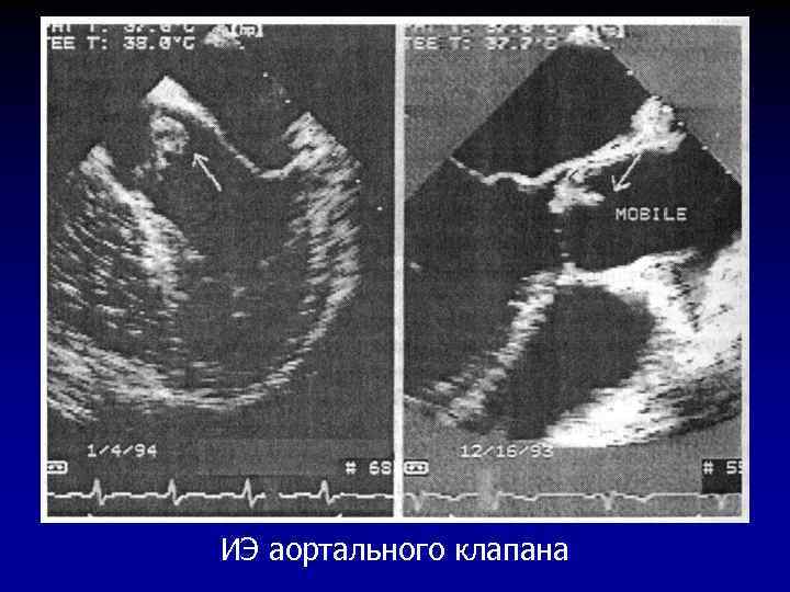 ИЭ аортального клапана 