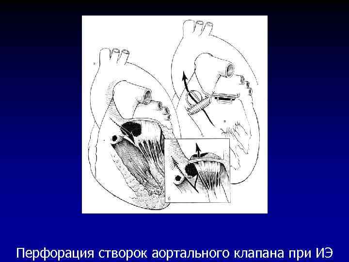 Перфорация створок аортального клапана при ИЭ 