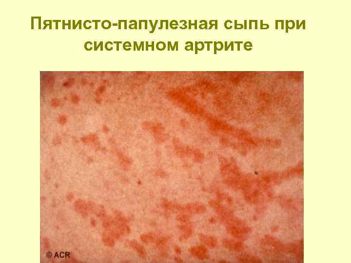 Пятнисто-папулезная сыпь при системном артрите 