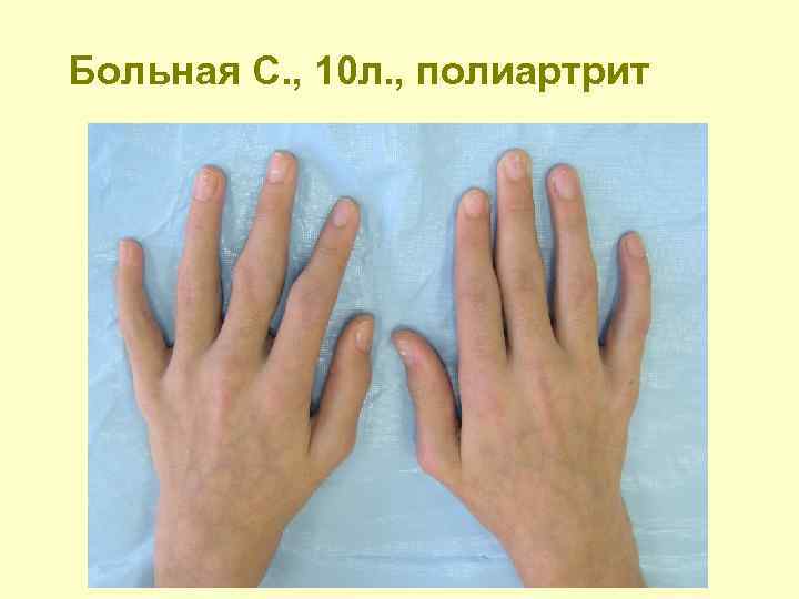 Больная С. , 10 л. , полиартрит 