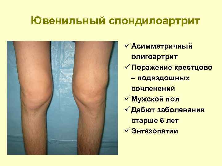 Ювенильный спондилоартрит ü Асимметричный олигоартрит ü Поражение крестцово – подвздошных сочленений ü Мужской пол