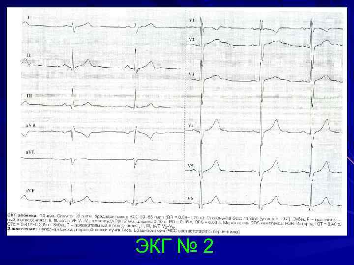 ЭКГ № 2 