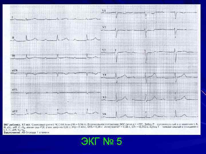 ЭКГ № 5 