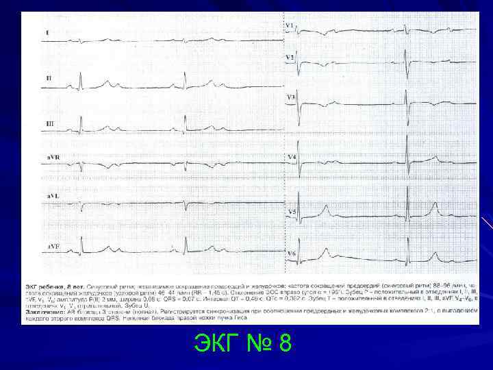 ЭКГ № 8 