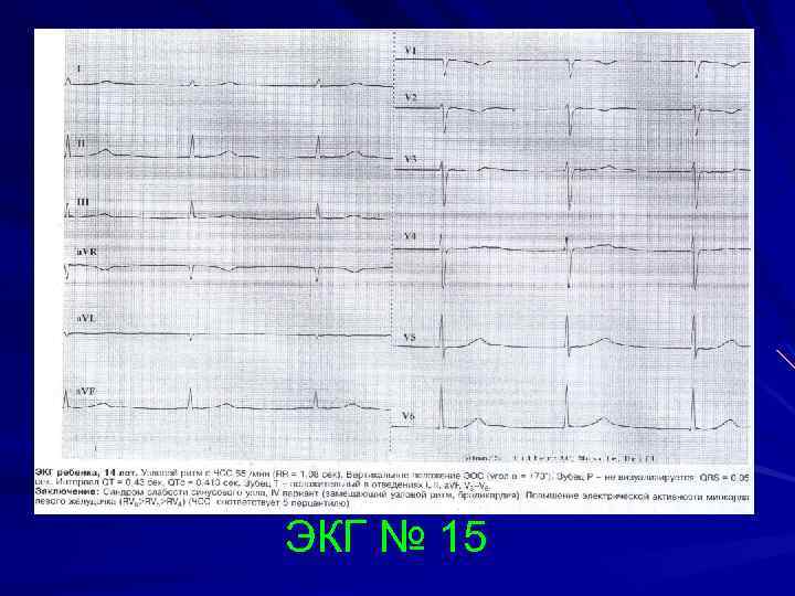 ЭКГ № 15 
