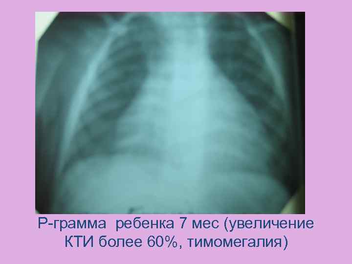 Р-грамма ребенка 7 мес (увеличение КТИ более 60%, тимомегалия) 