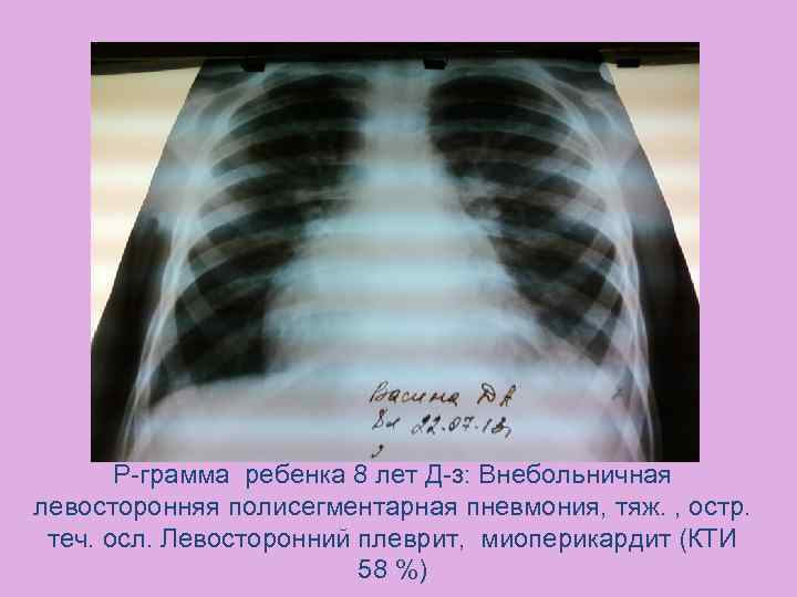 Р-грамма ребенка 8 лет Д-з: Внебольничная левосторонняя полисегментарная пневмония, тяж. , остр. теч. осл.