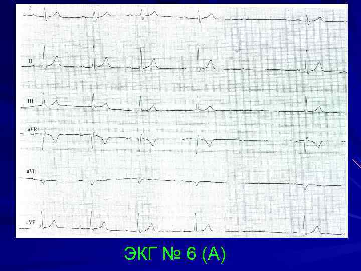 ЭКГ № 6 (А) 
