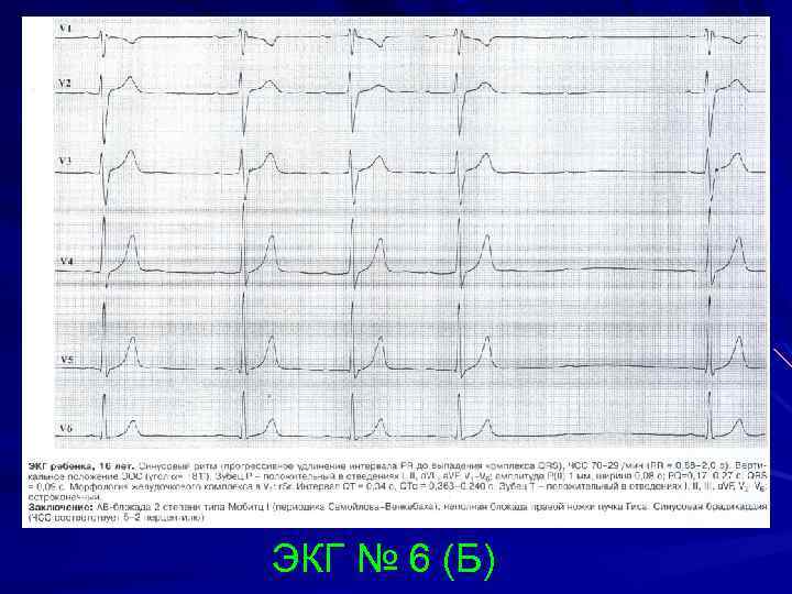 ЭКГ № 6 (Б) 