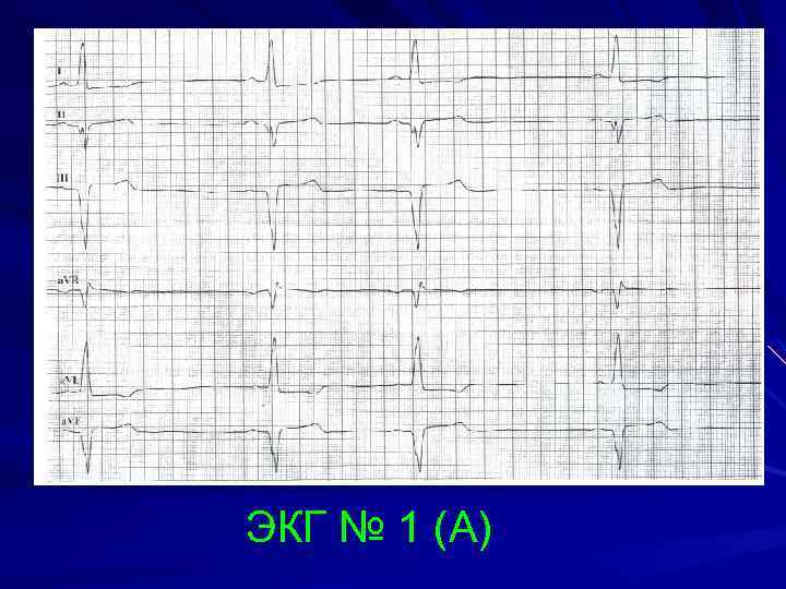ЭКГ № 1 (А) 