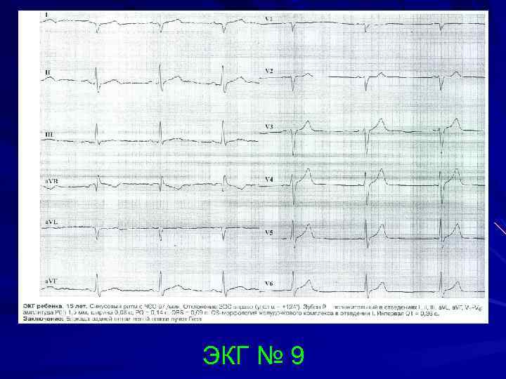 ЭКГ № 9 