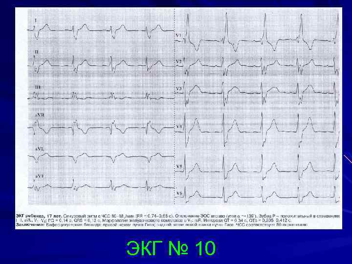 ЭКГ № 10 