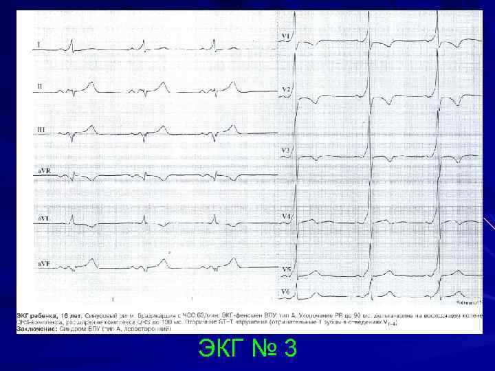 ЭКГ № 3 