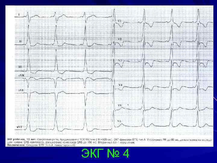 ЭКГ № 4 