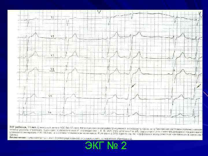 ЭКГ № 2 