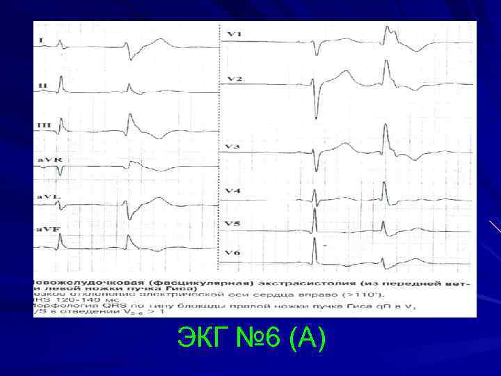 ЭКГ № 6 (А) 