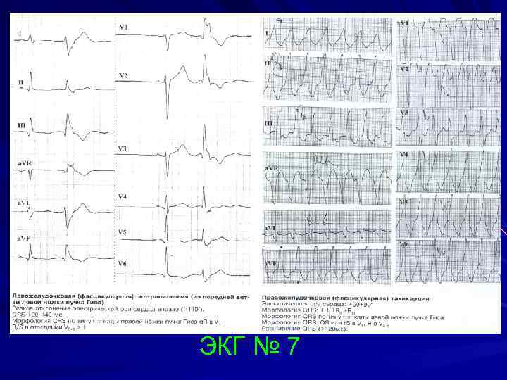 ЭКГ № 7 