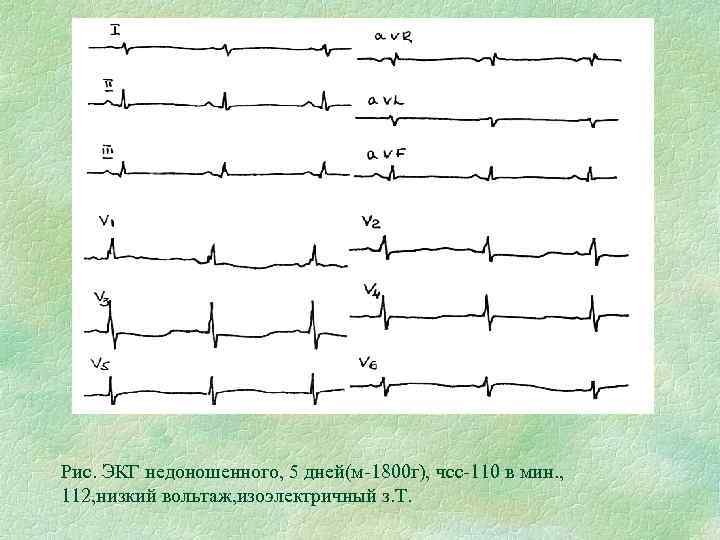 Рис. ЭКГ недоношенного, 5 дней(м-1800 г), чсс-110 в мин. , 112, низкий вольтаж, изоэлектричный