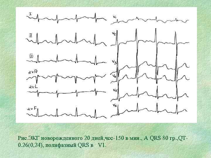 Рис. ЭКГ новорожденного 20 дней, чсс-150 в мин. , А QRS 80 гр. ,