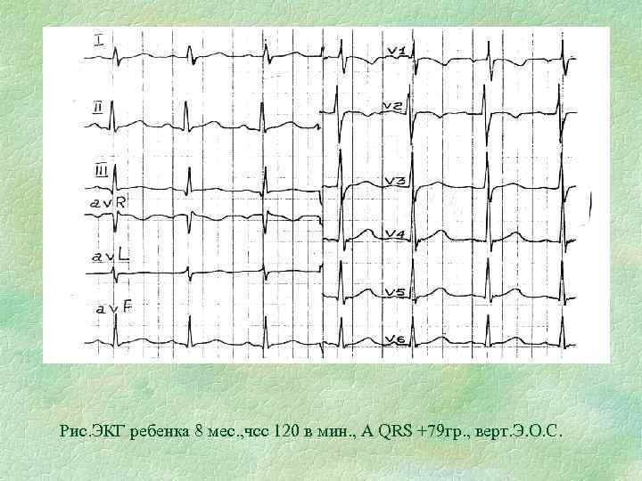 Рис. ЭКГ ребенка 8 мес. , чсс 120 в мин. , А QRS +79