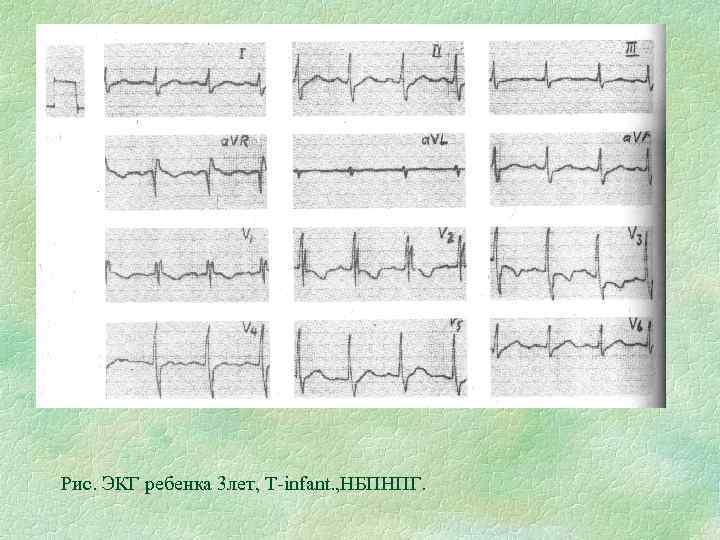 Рис. ЭКГ ребенка 3 лет, Т-infant. , НБПНПГ. 