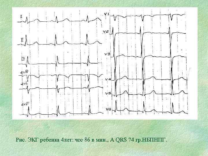 Рис. ЭКГ ребенка 4 лет: чсс 86 в мин. , А QRS 74 гр.