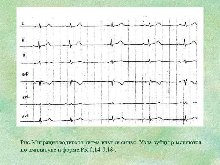 Рис. Миграция водителя ритма внутри синус. Узла-зубцы р меняются по амплитуде и форме, РR