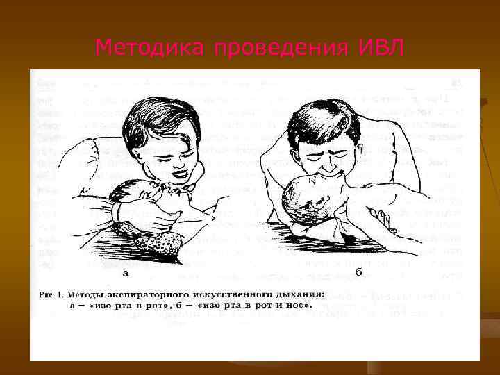 Методика проведения ИВЛ 