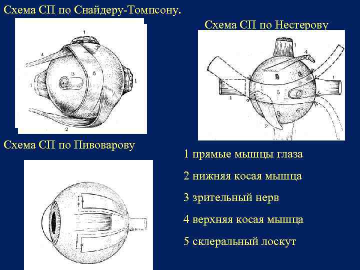 Схема СП по Снайдеру-Томпсону. Схема СП по Нестерову Схема СП по Пивоварову 1 прямые
