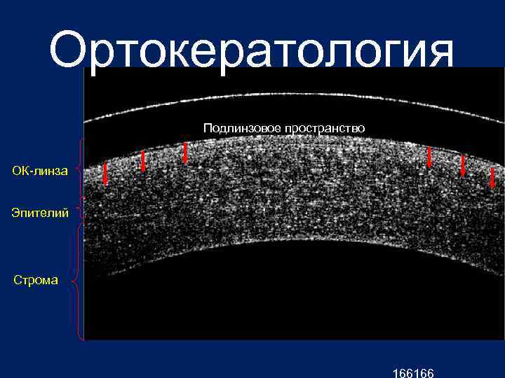 Ортокератология Подлинзовое пространство ОК-линза Эпителий Строма 