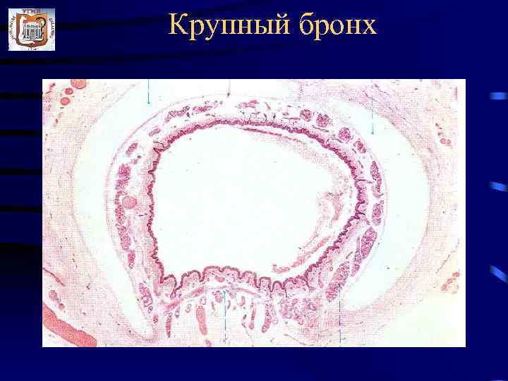 Крупный бронх 