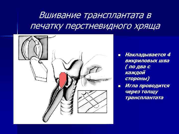 Вшивание трансплантата в печатку перстневидного хряща n n Накладывается 4 викриловых шва ( по