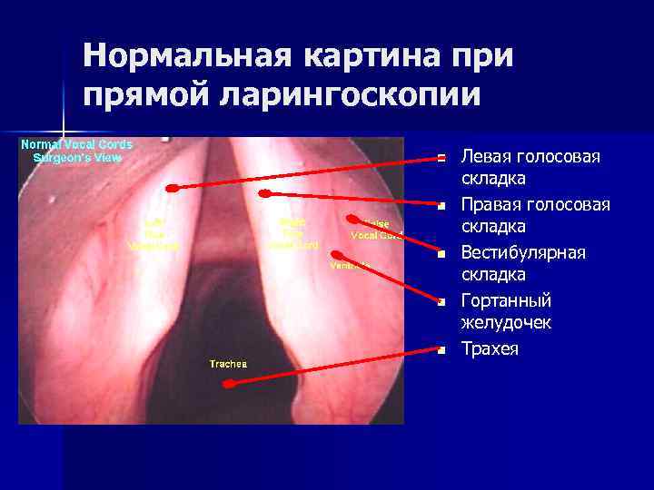 Нормальная картина при прямой ларингоскопии n n n Левая голосовая складка Правая голосовая складка