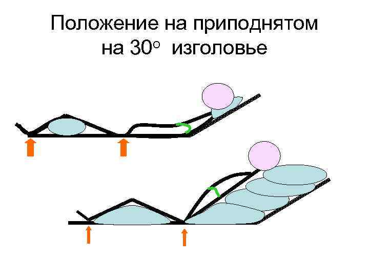 Положение на приподнятом на 30 о изголовье 