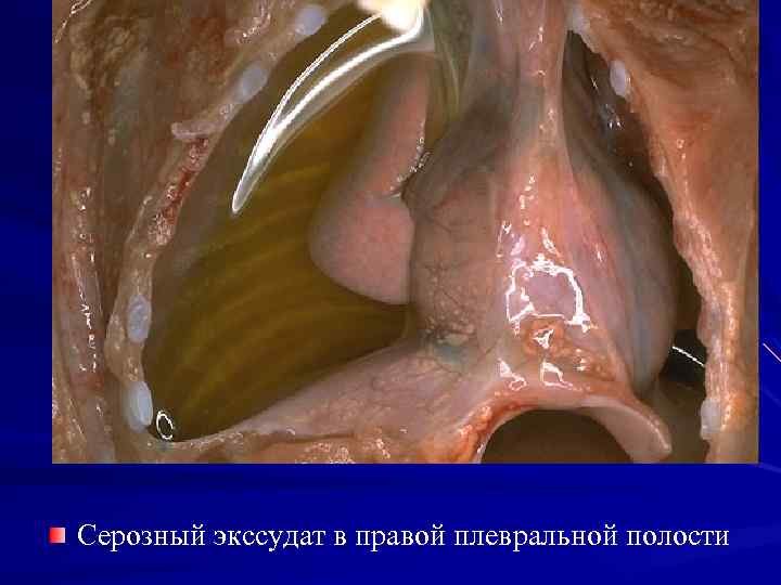 Серозный экссудат в правой плевральной полости 