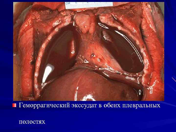 Геморрагический экссудат в обеих плевральных полостях 