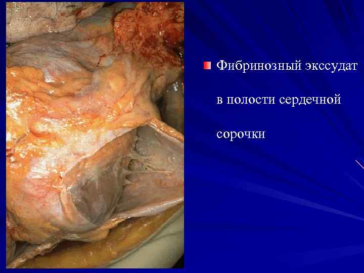 Фибринозный экссудат в полости сердечной сорочки 