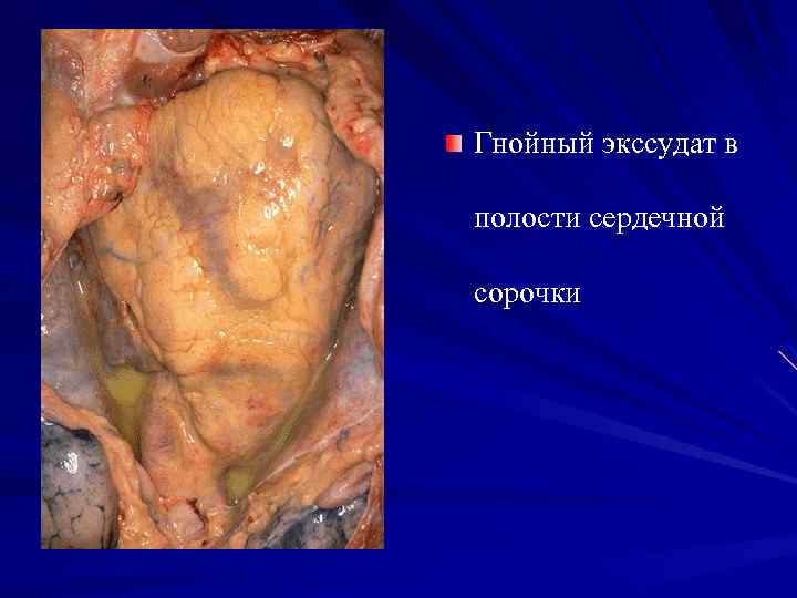 Гнойный экссудат в полости сердечной сорочки 