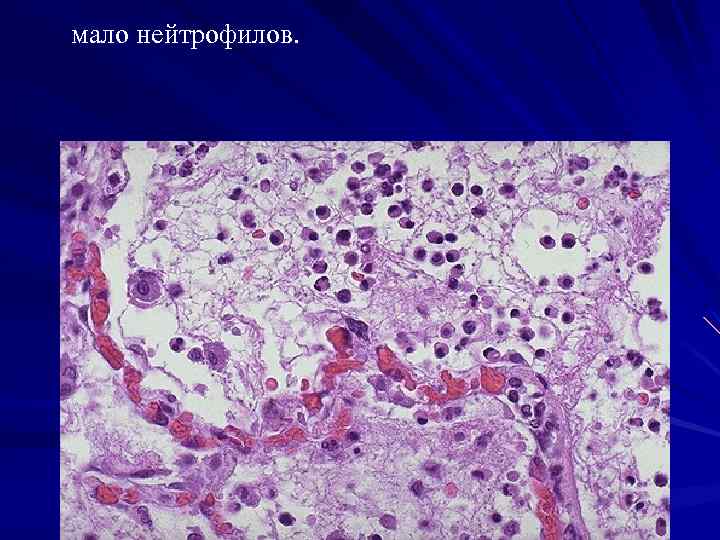 мало нейтрофилов. 