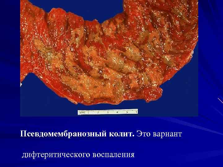 Псевдомембранозный колит. Это вариант дифтеритического воспаления 