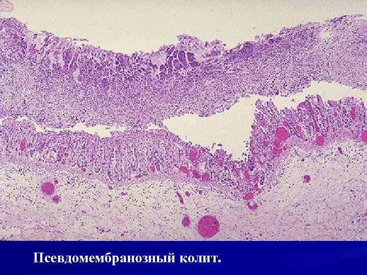Псевдомембранозный колит. 