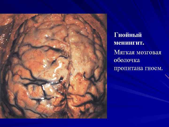 Гнойный менингит. Мягкая мозговая оболочка пропитана гноем. 