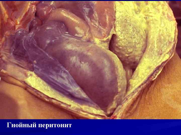 Гнойный перитонит 