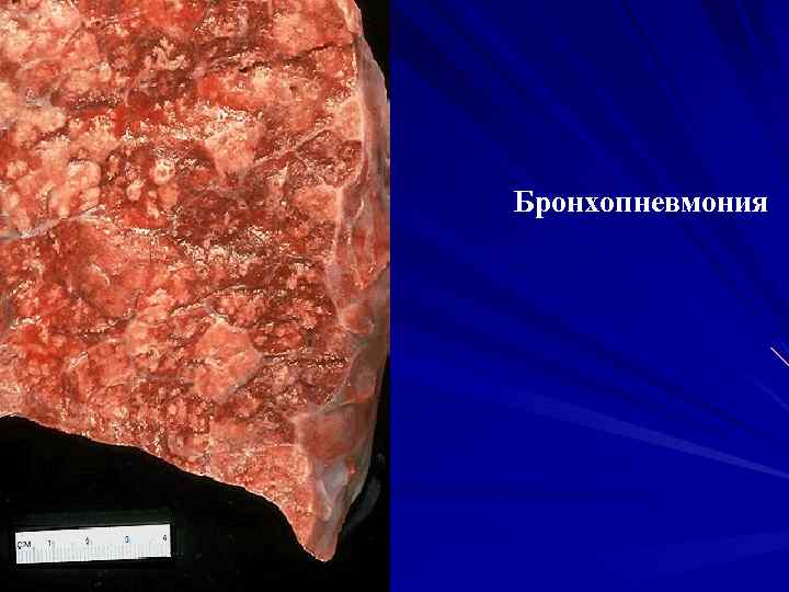 Бронхопневмония 