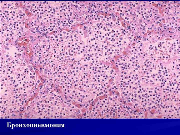 Бронхопневмония 