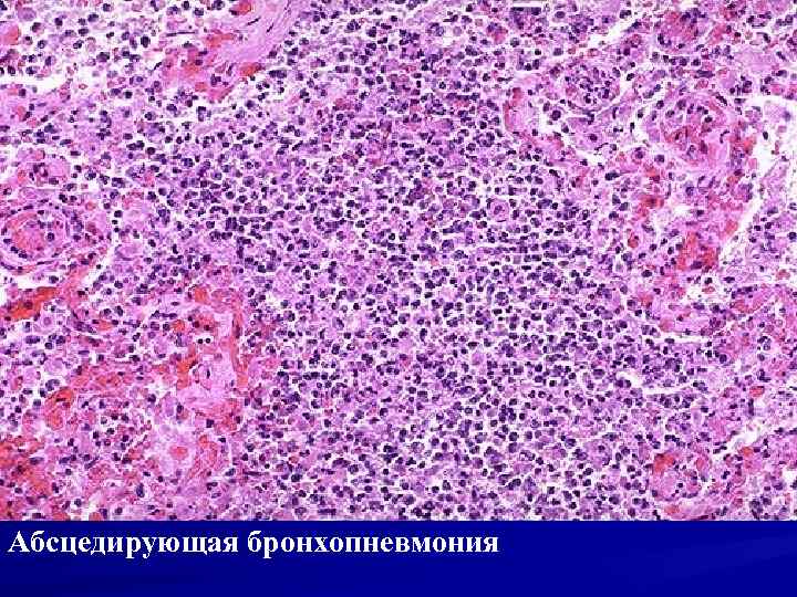 Абсцедирующая бронхопневмония 