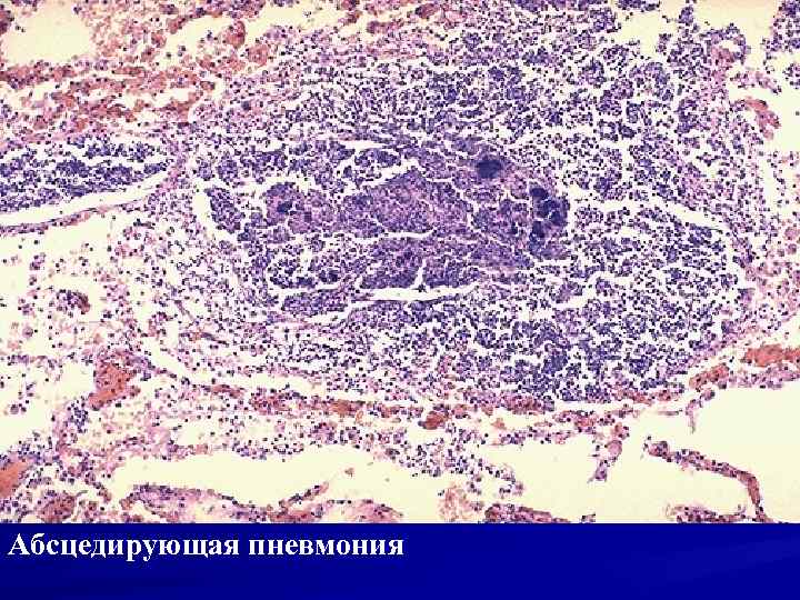 Абсцедирующая пневмония 