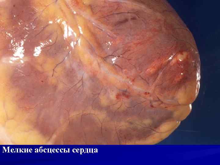 Мелкие абсцессы сердца 