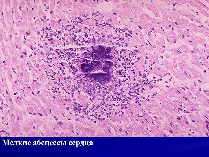 Мелкие абсцессы сердца 