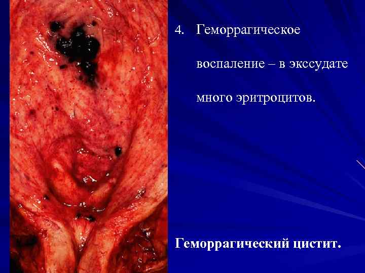 4. Геморрагическое воспаление – в экссудате много эритроцитов. Геморрагический цистит. 